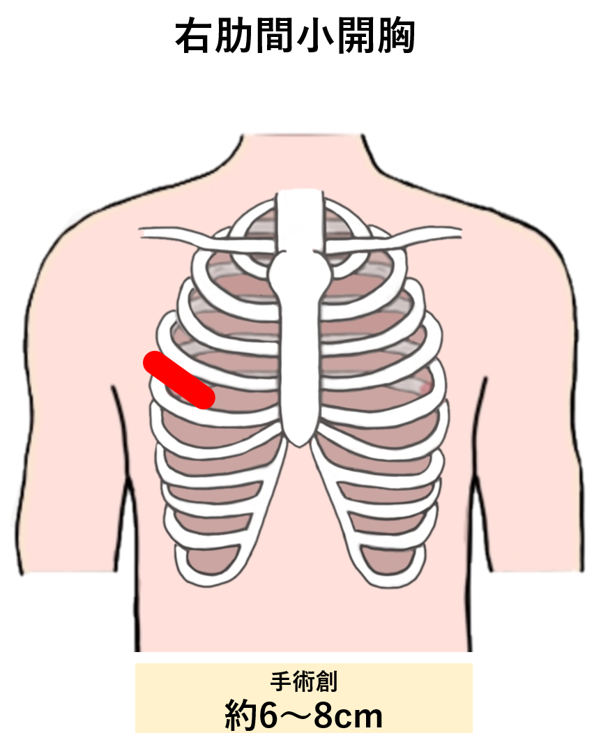 福山循環器病院（福山市）｜MICS（低侵襲心臓手術）