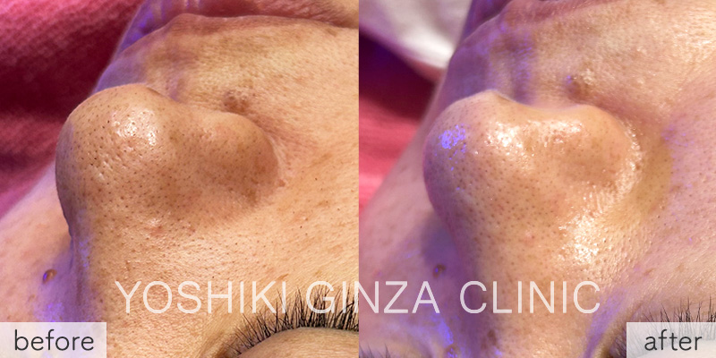 ハイドラフェイシャル｜よしき銀座クリニック