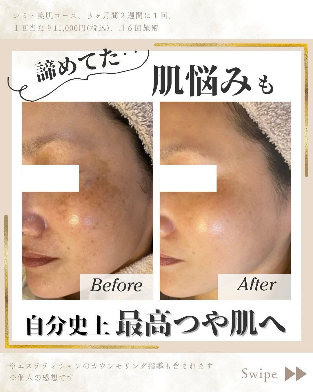 ぱくちー sonic 業務用シミとりエステ　super